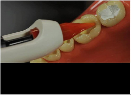 NBR ISO 4049 de 08/2017: os requisitos para materiais restauradores odontológicos