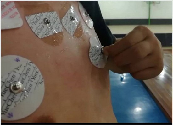 NBR 16628 de 09/2017: os requisitos para os eletrodos descartáveis usados em eletrocardiografia (ECG)