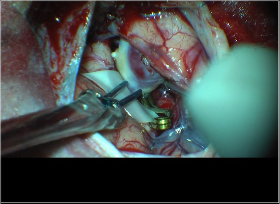 NBR ISO 9713 de 10/2017 e NBR ISO 7197 de 10/2017: os requisitos para os implantes neurocirúrgicos