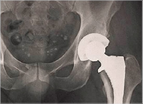 A inspeção radiográfica de componentes metálicos dos implantes para cirurgia