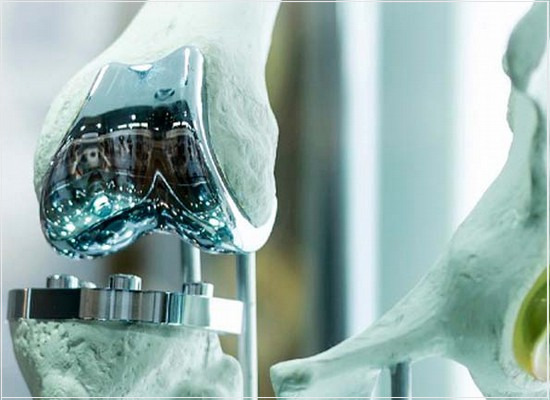 A conformidade dos implantes de liga cobalto-níquel-cromo-molibdênio