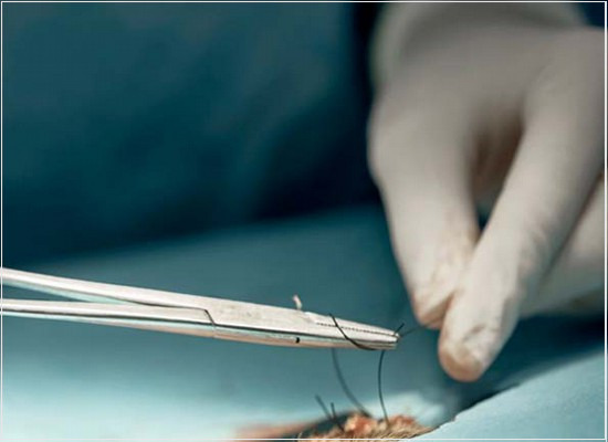 A fabricação conforme a norma técnica dos fios para sutura cirúrgica