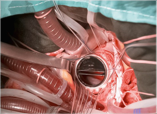 A conformidade das próteses valvulares cardíacas