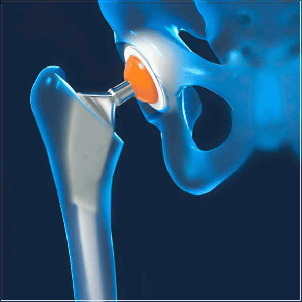 O projeto de implantes para a cirurgia fabricados por manufatura aditiva