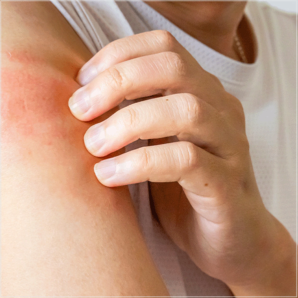 Os procedimentos para os ensaios de irritação dos dispositivos médicos